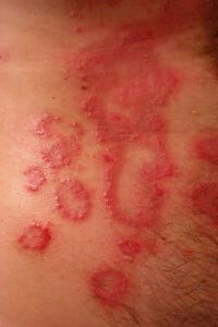 psoriasi